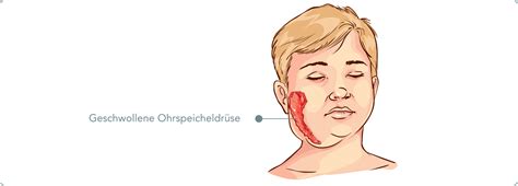mumpd|mumps symptome bei erwachsenen.